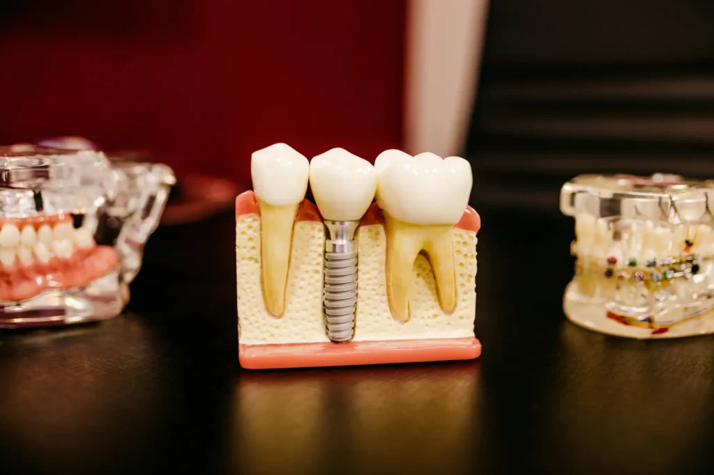 Dental procedure